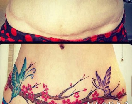 腹部刀疤遮盖梅花纹身图案