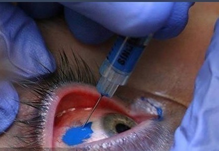 眼睛纹身:眼睛上的荧光纹身