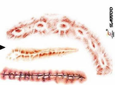 疤痕伤口纹身手稿