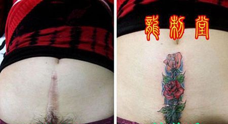 女性剖腹产疤痕玫瑰花图案遮盖纹身缩略频道推荐图