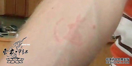 奇葩纹身：男子被上千只臭虫叮咬竟没事