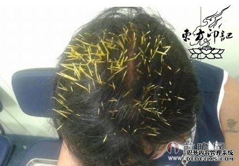 巴西纹身女子外出遛狗 天降豪猪正中其头