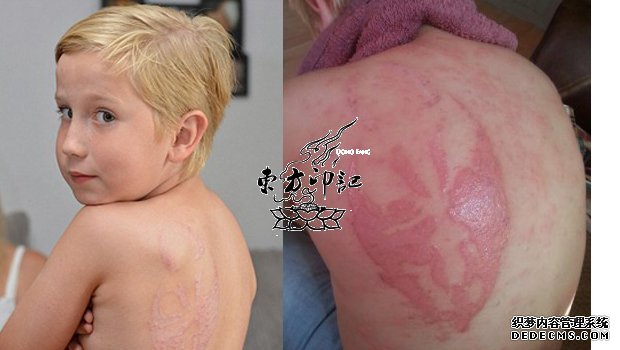 指甲花纹身引起感染，纹身需谨慎