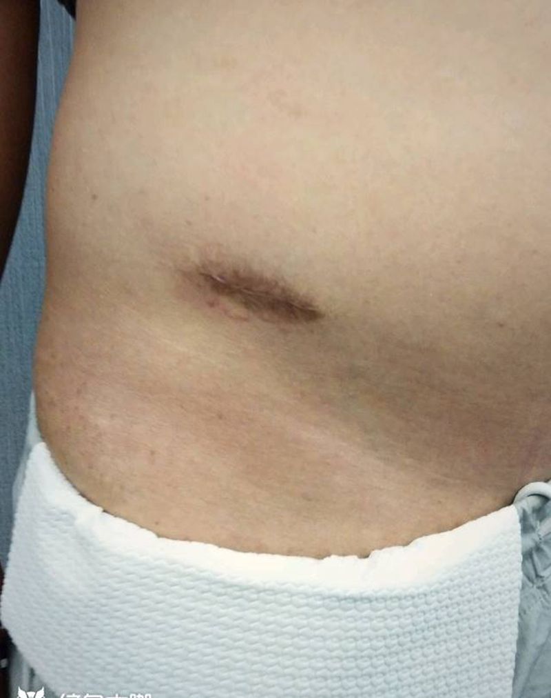 疤痕遮盖纹身图片