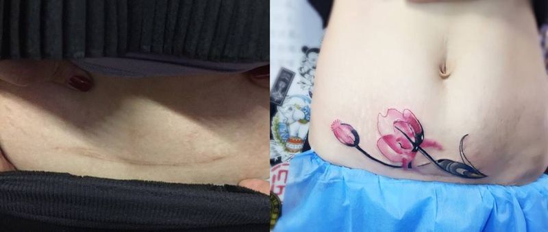 覆盖抛妇产疤痕纹身图片