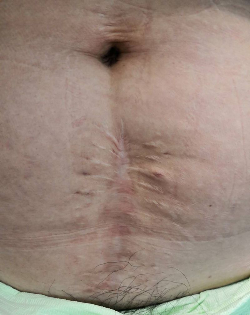 剖腹产伤疤遮盖纹身图片