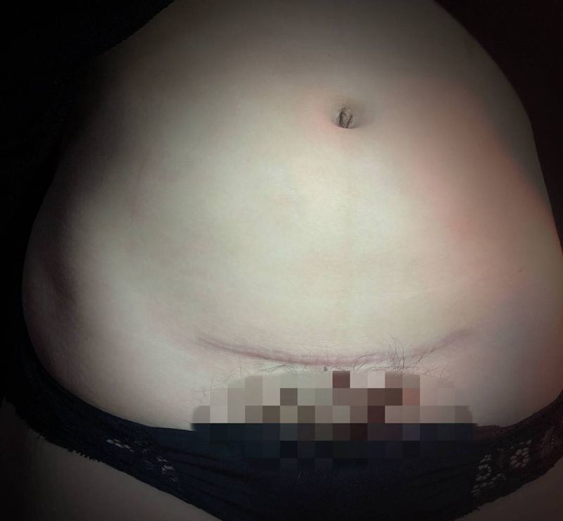 遮盖剖腹产手术疤痕纹身图片_腹部纹身图案