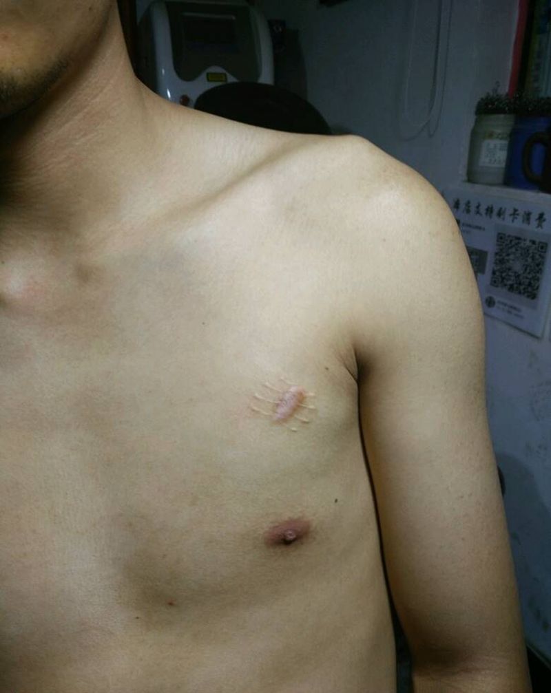 疤痕遮盖蜈蚣纹身图片