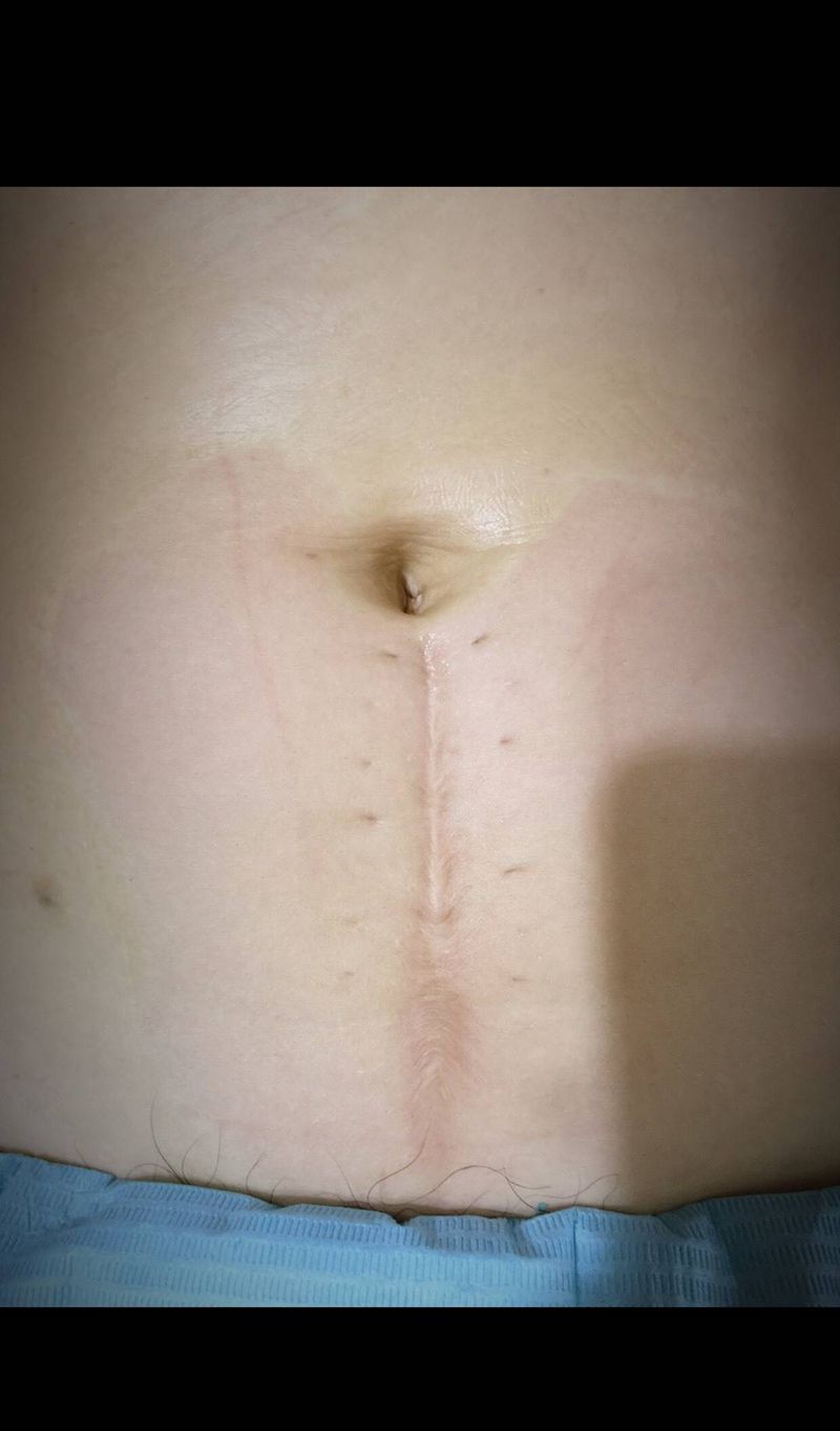 遮盖产后疤（遮盖前 遮盖后）纹身图片