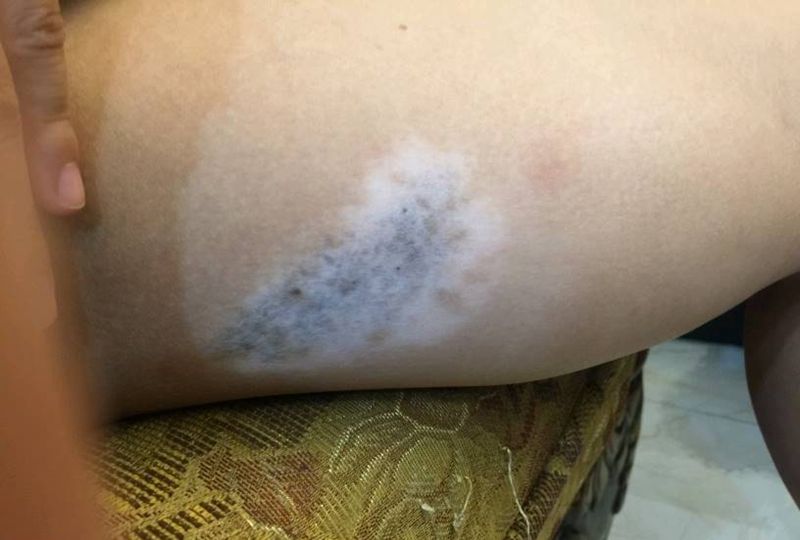 疤痕遮盖素花纹身图片_手臂点刺小清新纹身图案