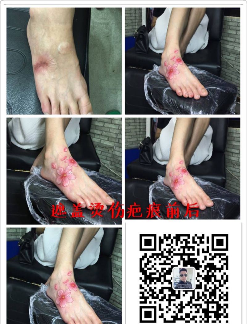 烫伤疤痕遮盖纹身图片