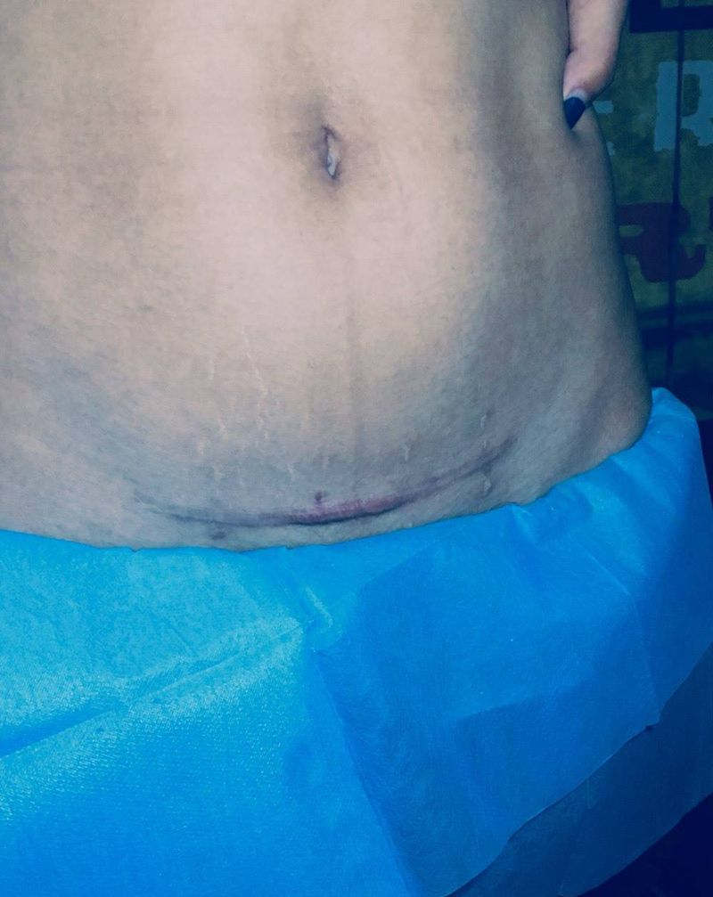 遮盖剖腹产手术疤痕纹身图片