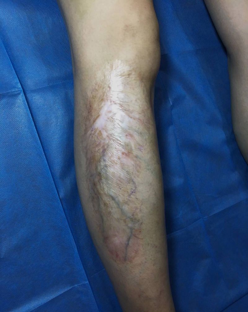 遮盖烫伤疤痕纹身图片