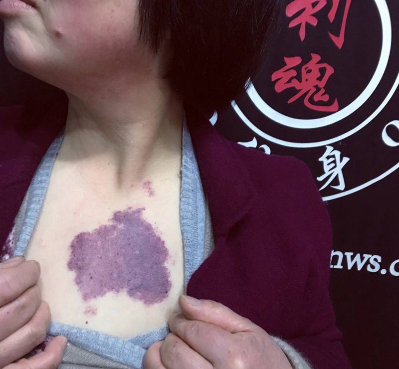 遮盖六十多年的胎记纹身图片