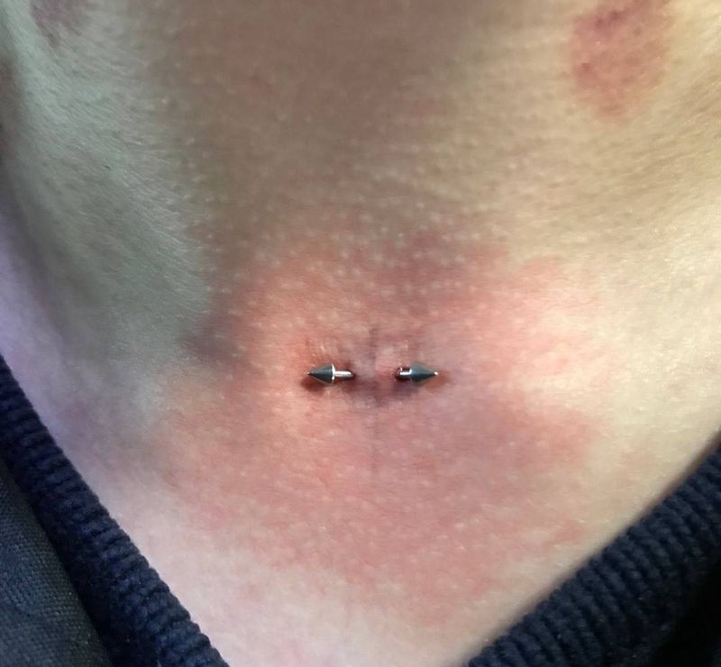 锁骨上窝钉  请忽略脖子处印记