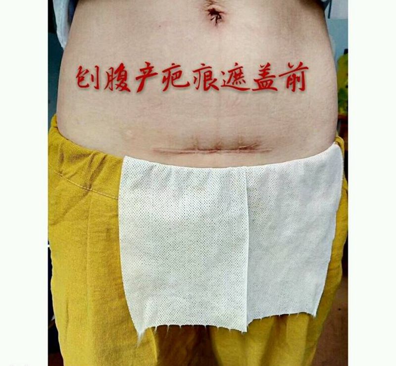 刨腹产疤痕遮盖，泰安店作品纹身图片