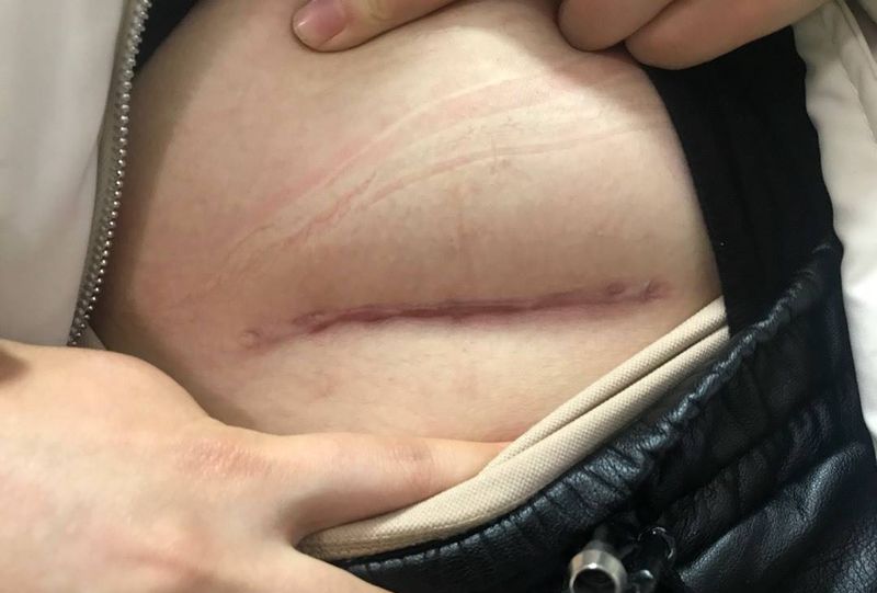 遮盖剖腹产纹身图片