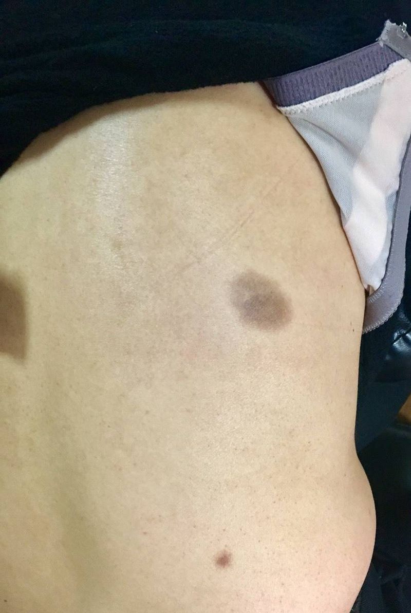 胎记遮盖。。纹身图片