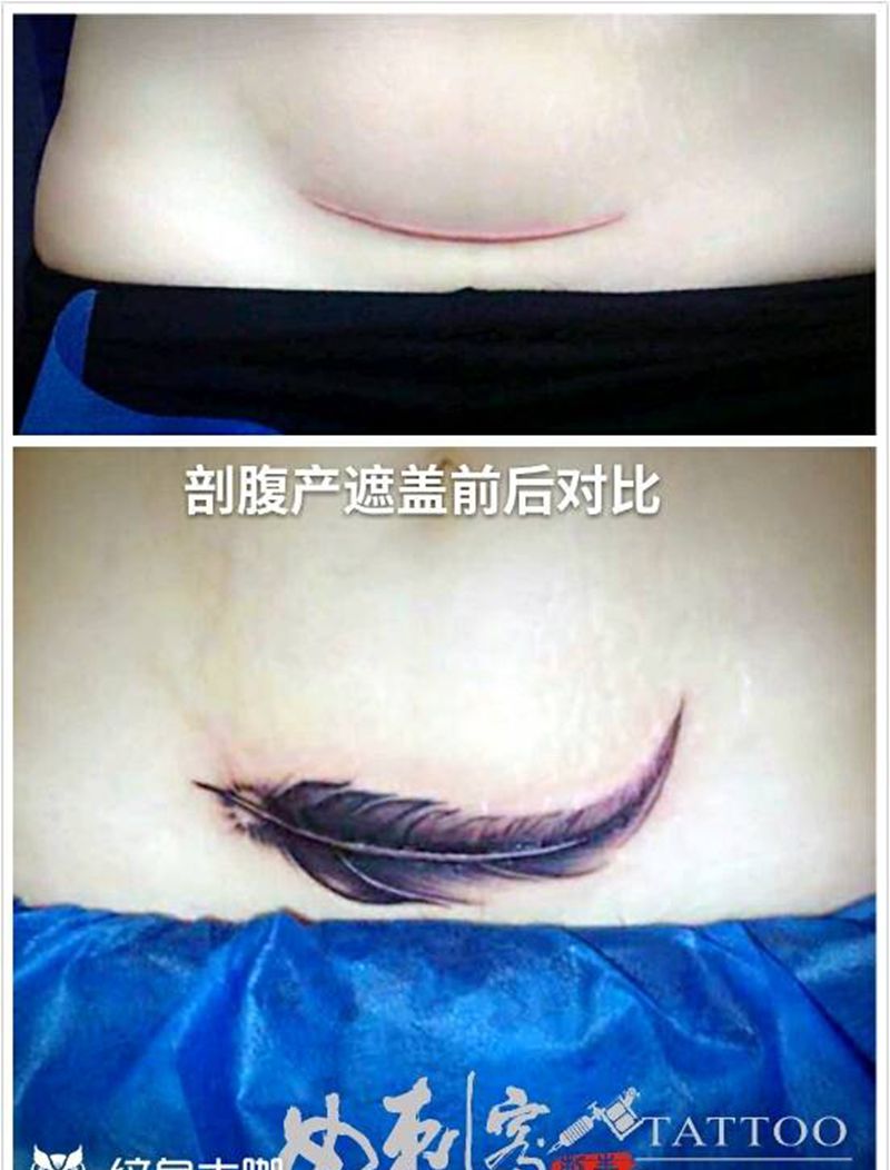 剖腹产遮盖纹身图片