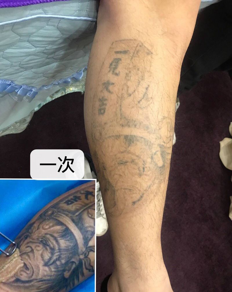 洗纹身不留疤纹身图片_洗纹身图案