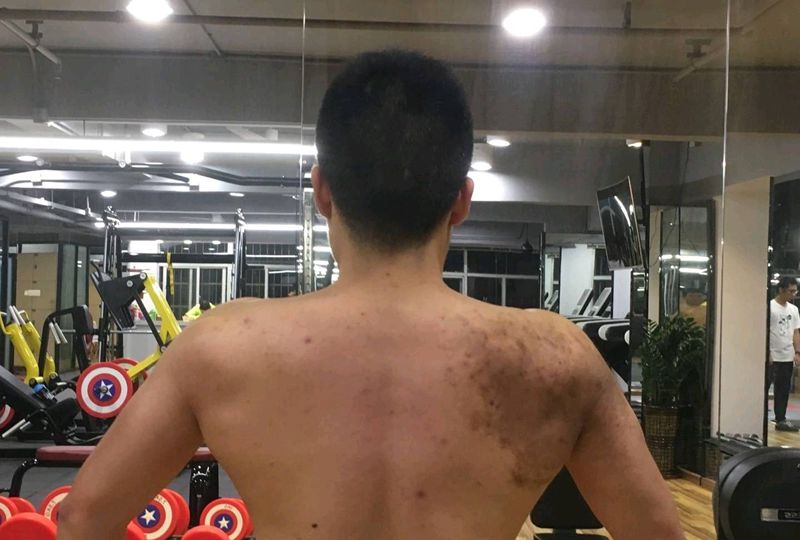 胎记遮盖，特价鲫鱼。纹身图片