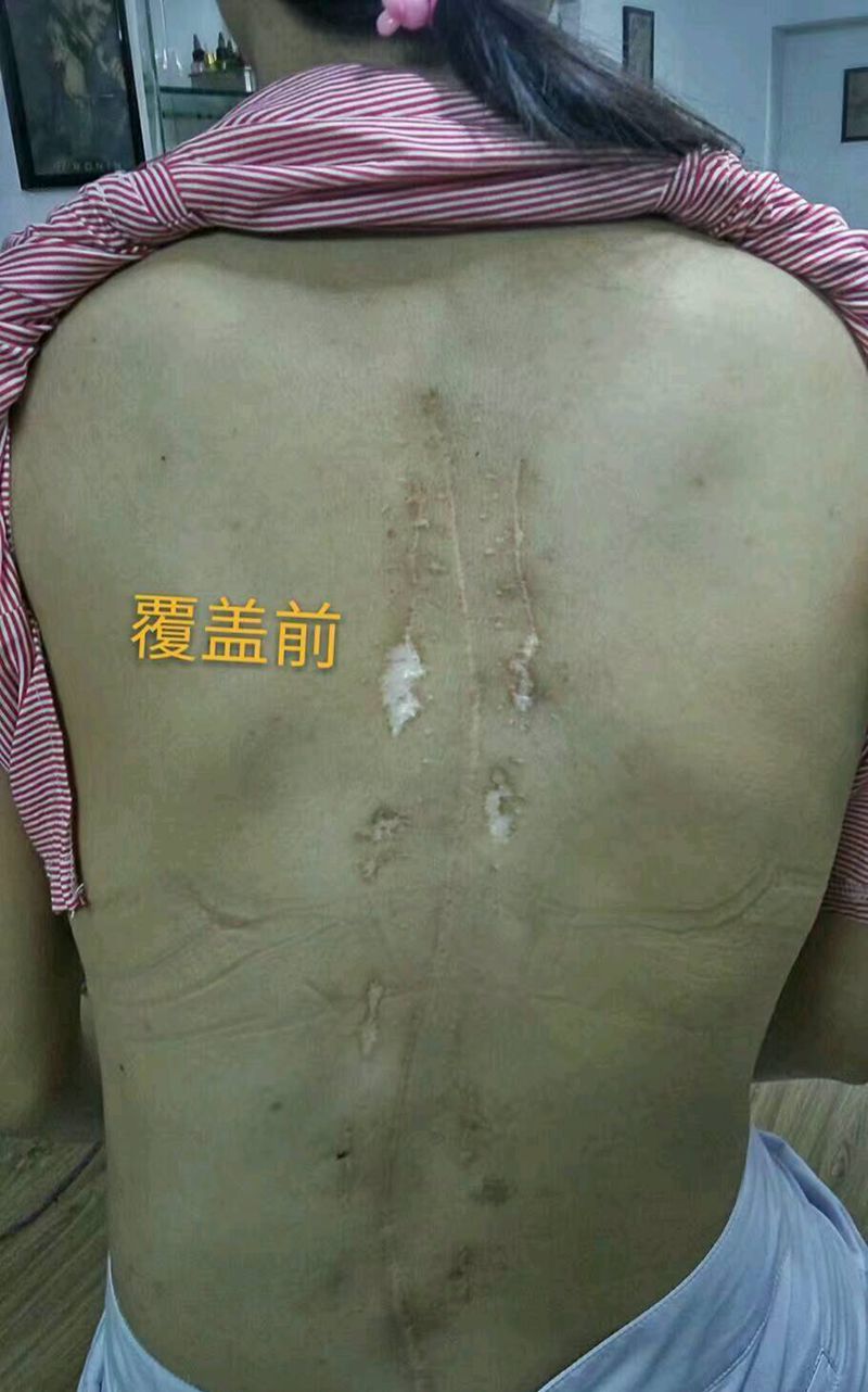 莲花覆盖疤痕纹身图片