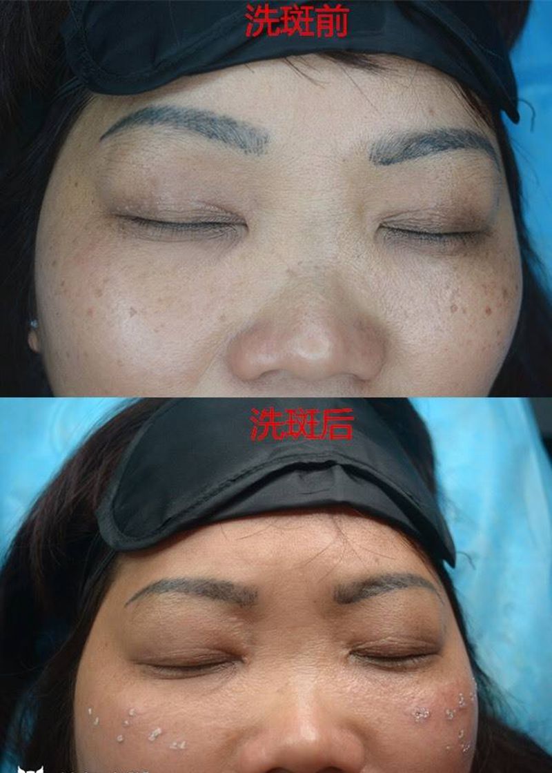 #洗斑#,有需要请私信我纹身图片