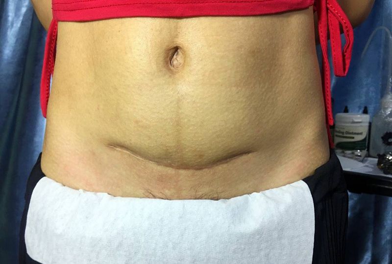 剖腹产疤痕遮盖纹身图片