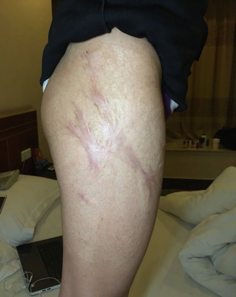 伤疤遮盖纹身图片