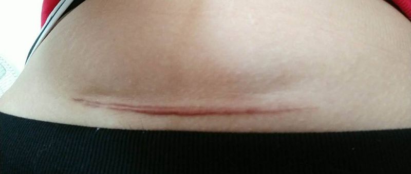 遮盖剖腹产疤痕纹身图片