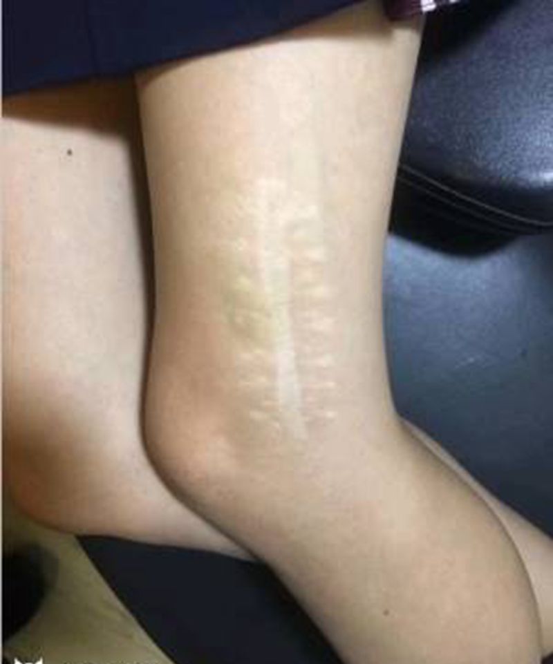 伤疤遮盖纹身图片