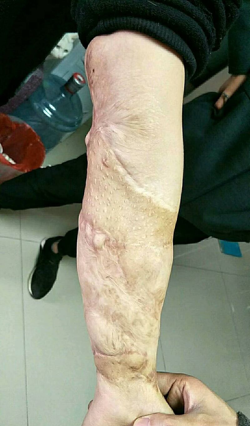 疤痕遮盖纹身图片_手臂传统纹身图案