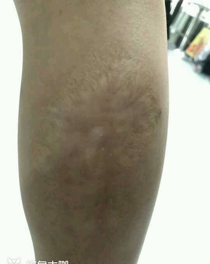 伤疤遮盖纹身图片