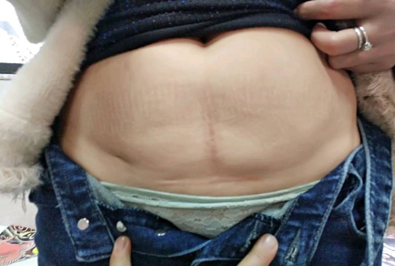遮盖剖腹产疤痕纹身图片