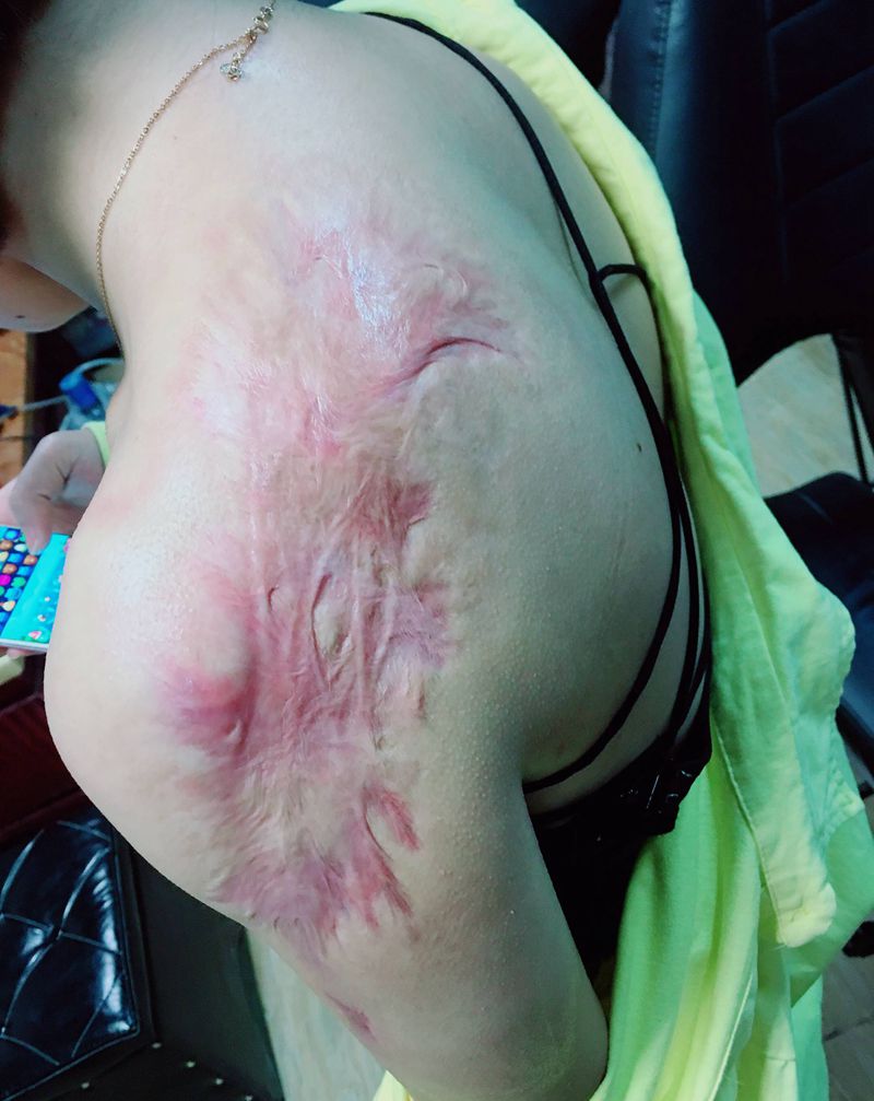 疤痕大型强盖，告别夏日露背尴尬纹身图片_肩部纹身图案