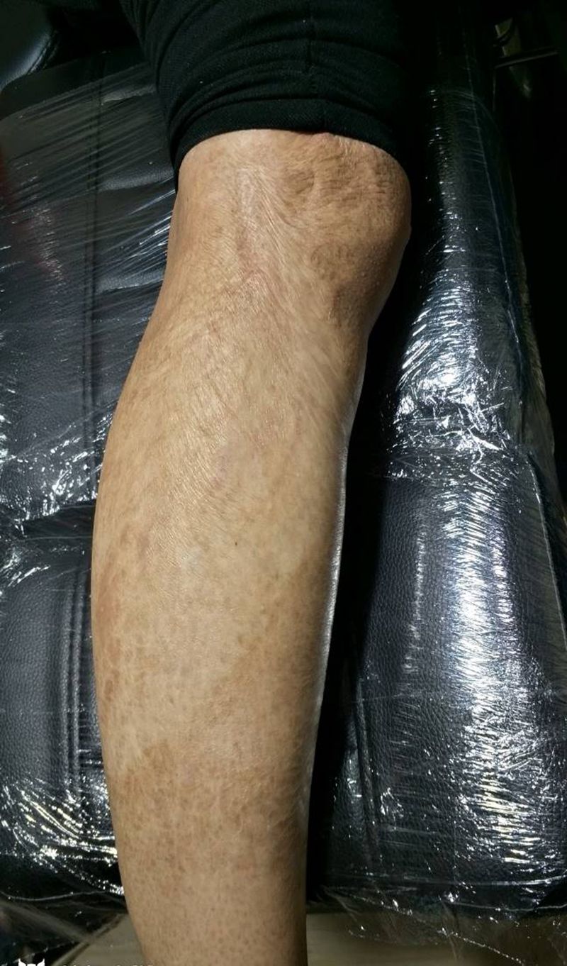 素花遮盖烫伤纹身图片_腿部清新植物成品纹身图案