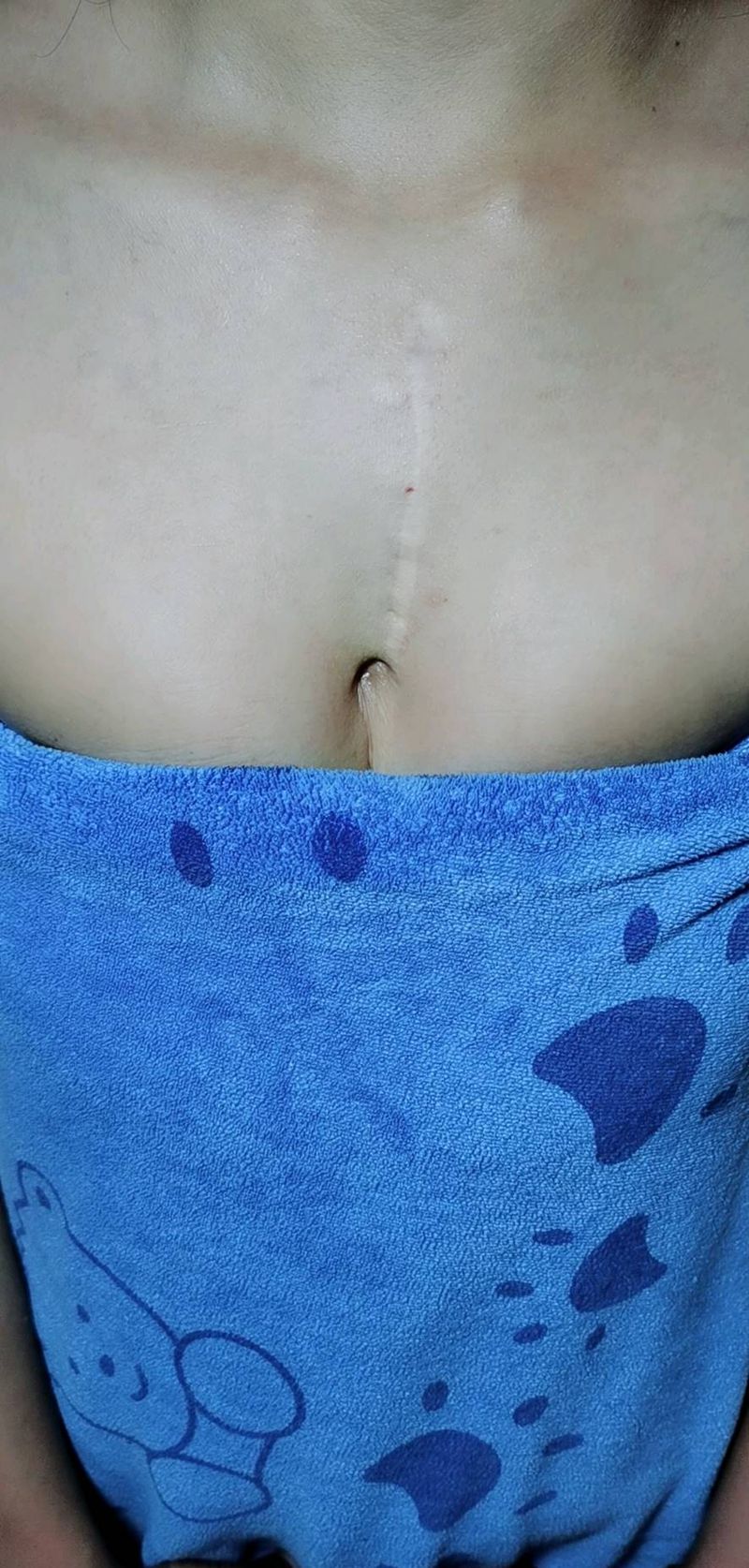 花体字 遮盖 手术疤痕纹身图片_胸部几何纹身图案