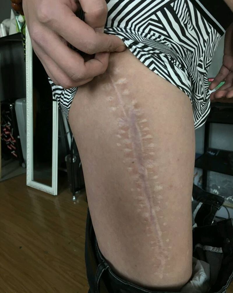 遮盖超大手术疤痕纹身图片_腿部纹身图案