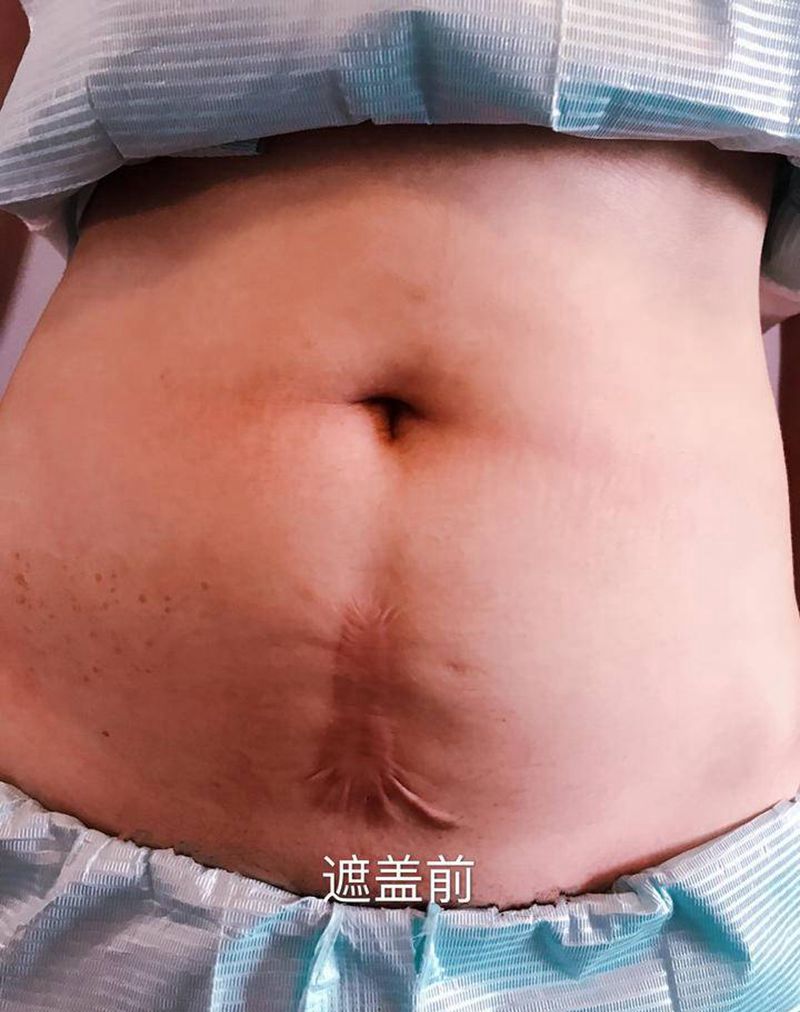 疤痕遮盖作品纹身图片_腹部手臂水彩点刺纹身图案