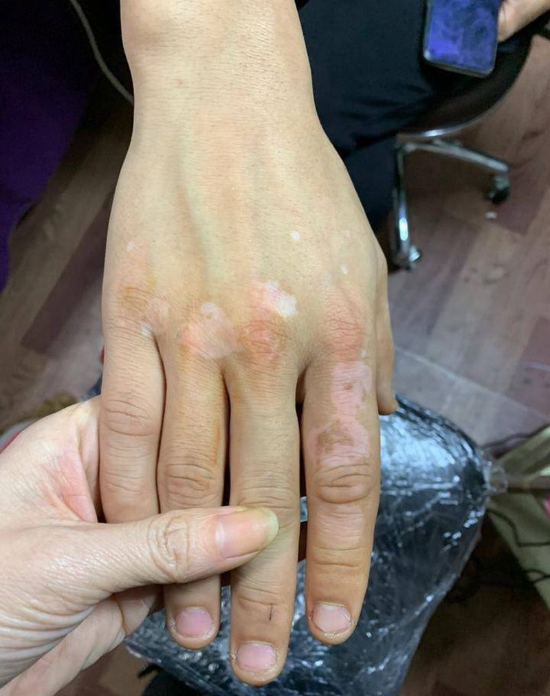 白癜风肤色遮盖纹身图片