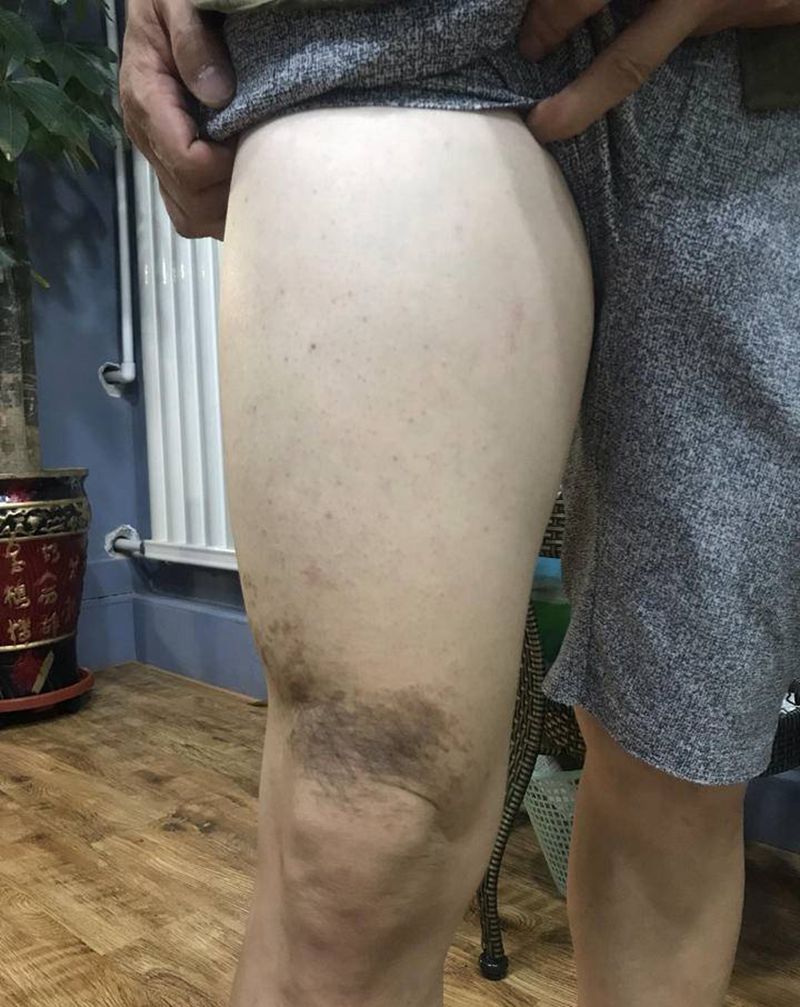 鹿 胎记遮盖纹身图片_腿部纹身图案