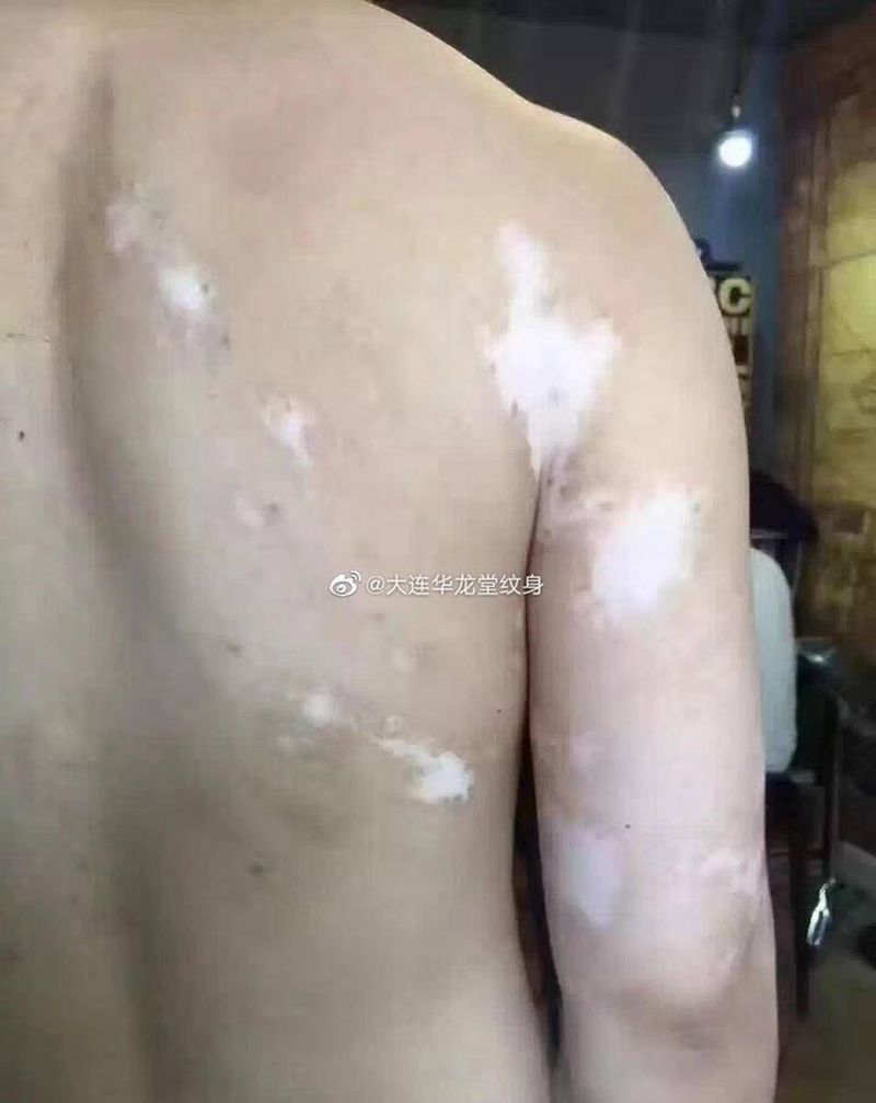 白癜风遮盖作品纹身图片_水墨纹身图案