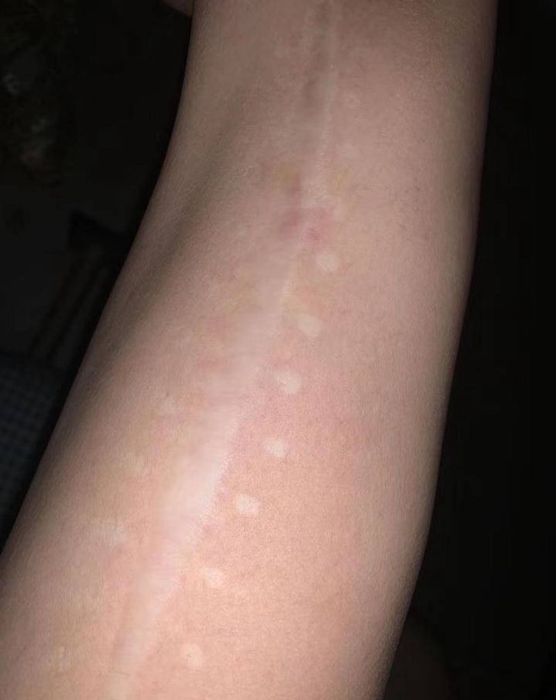 疤痕遮盖纹身图片_腿部点刺纹身图案