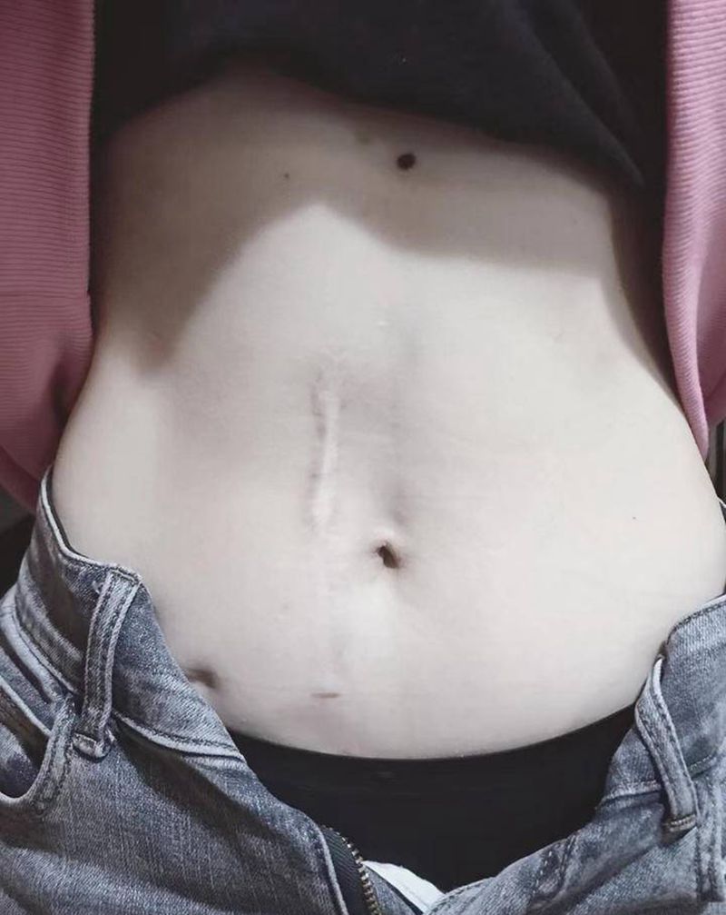 遮掉不开心系列之手术疤痕遮盖纹身图片_腹部纹身图案