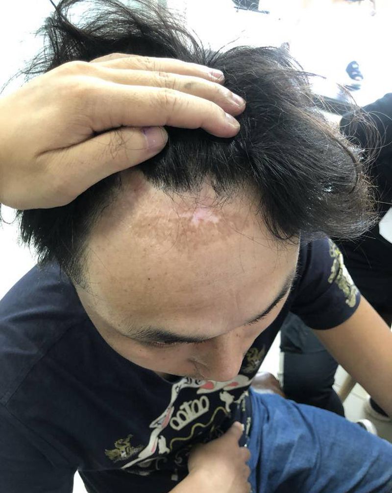 疤痕遮盖纹身图片_鲨鱼纹身图案