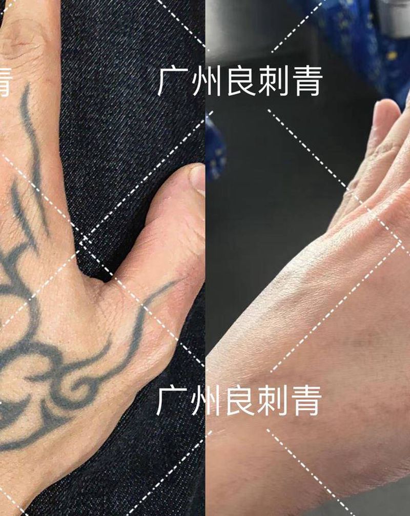 皮秒洗纹身纹身图片_洗纹身图案