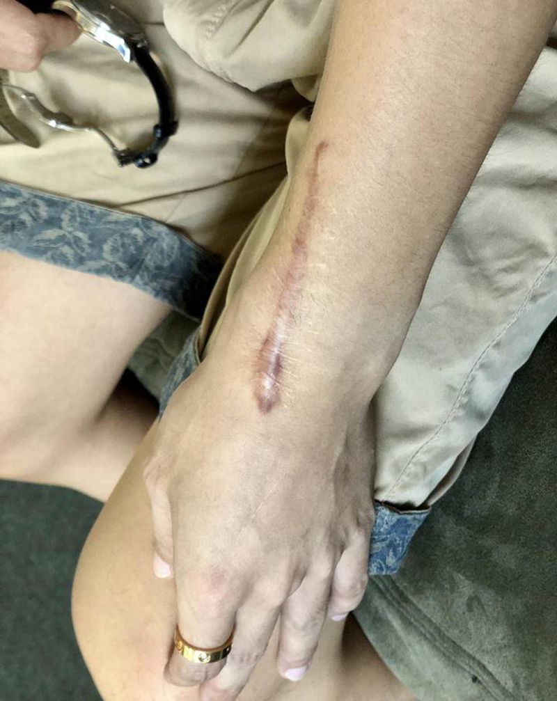 疤痕覆盖纹身图片_手臂点刺New School纹身图案