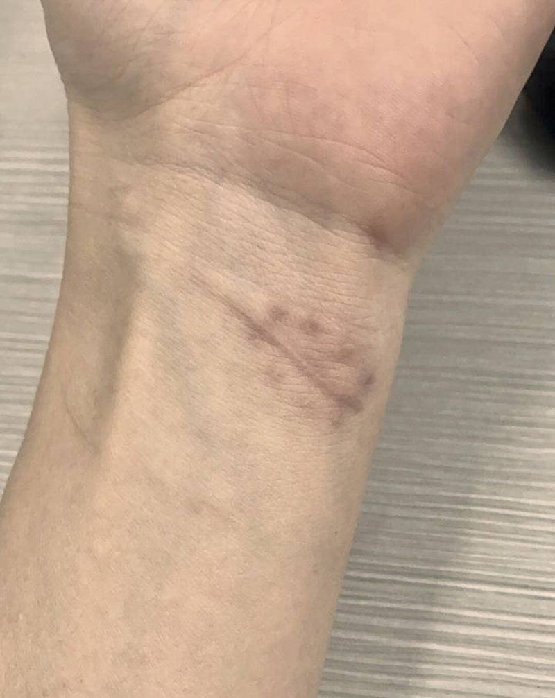 疤痕覆盖～太阳纹身图片_手臂点刺几何纹身图案