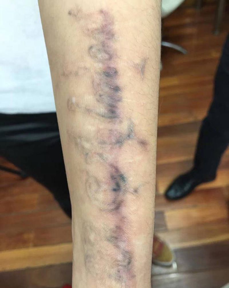 洗纹身+疤痕修复纹身图片_手臂纹身图案