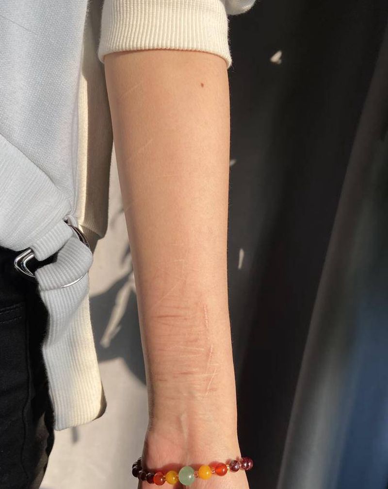 疤痕遮盖纹身图片_手臂纹身图案